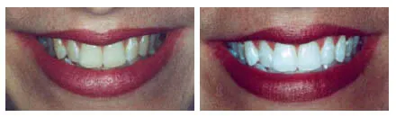 Teeth Whitening